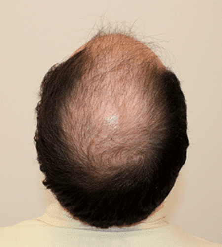 Antes del tratamiento