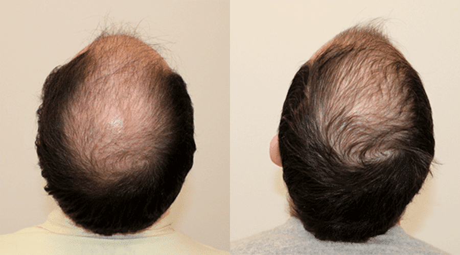 Resultado de injerto capilar — caso antes y después