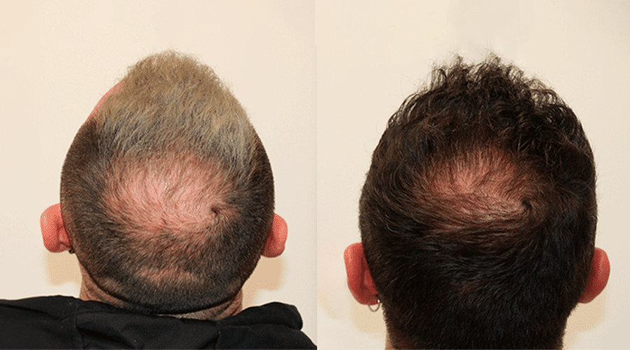 Caso 2 — Resultado antes y después de tratamiento de alopecia
