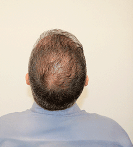 Antes del tratamiento