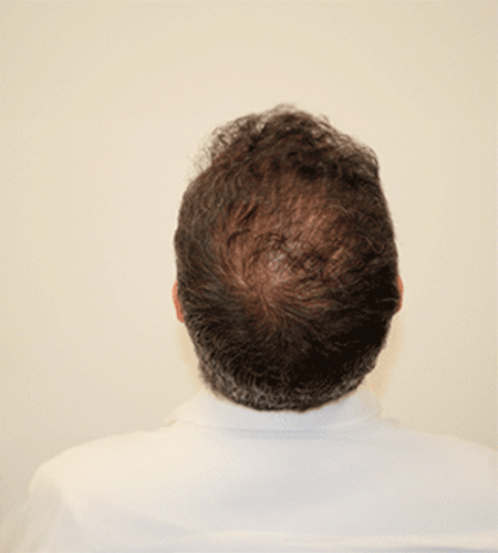 Después del tratamiento