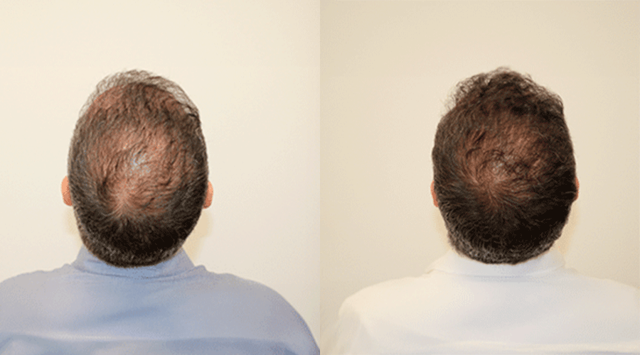 Resultado de injerto capilar — caso antes y después