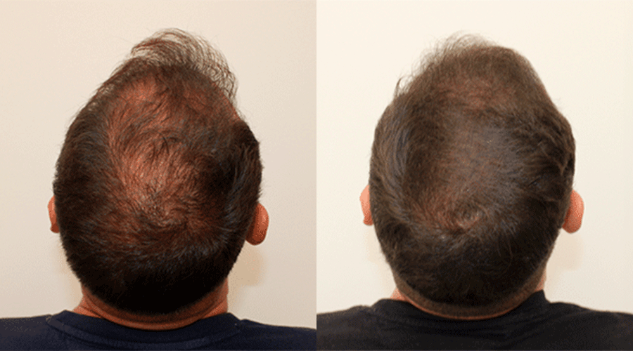 Caso 4 — Resultado antes y después de injerto capilar FUE