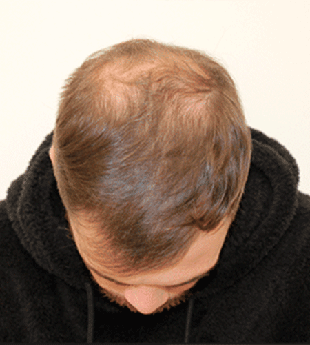 Antes del tratamiento