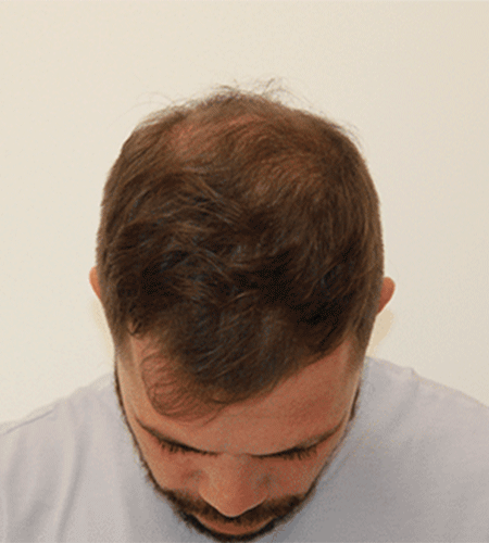 Después del tratamiento