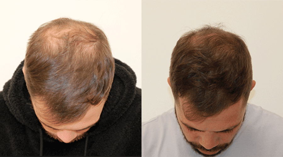 Resultado de injerto capilar — caso antes y después