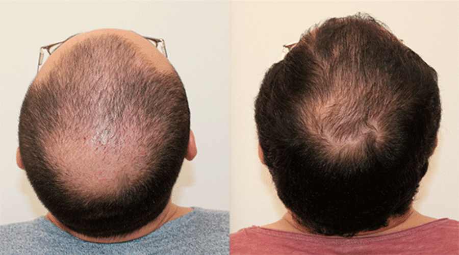 Caso 6 — Resultado antes y después de alopecia avanzada