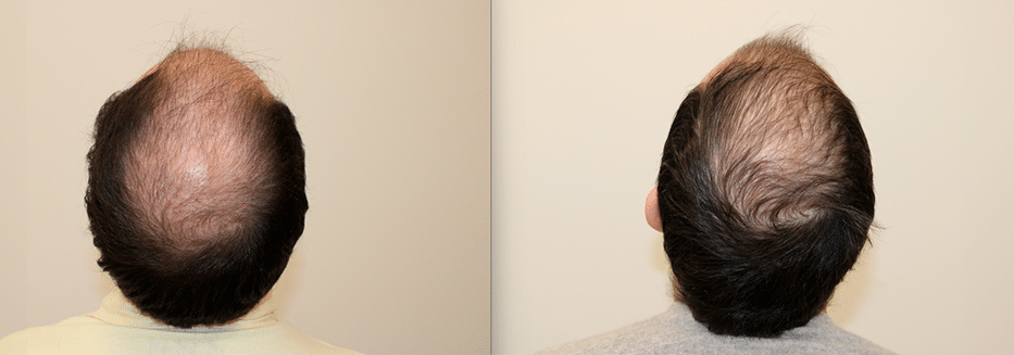 Mesoterapia con aminoácidos — tratamiento capilar en Valencia