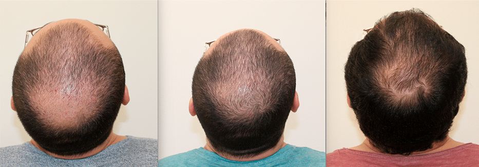 Biorevitalización capilar — tratamiento en Valencia