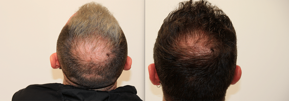 Mesoterapia capilar con biotina