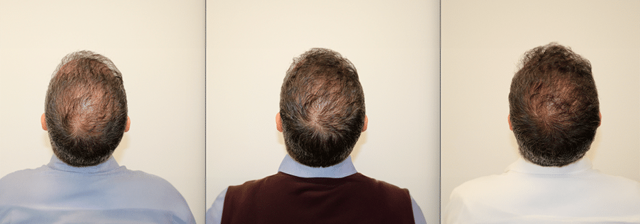 PRP y factores biológicos capilares