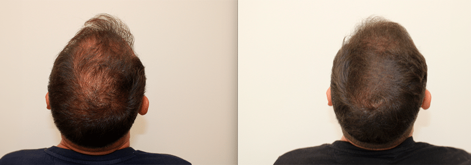 Tratamiento farmacológico capilar — Hair & Be Valencia