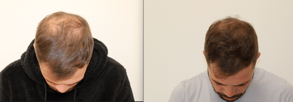 Mesoterapia con minerales y oligoelementos — tratamiento capilar en Valencia