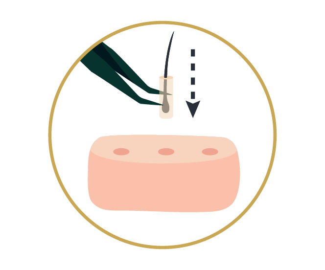 Implantación con cuchilla de zafiro